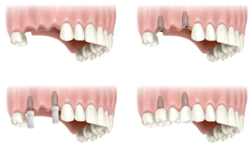 two-tooth-implant.jpg