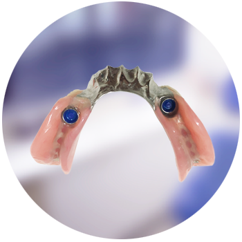 implantsupppartialdenture02.png