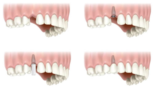 single-tooth-implant.jpg
